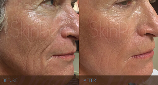 SkinPen voor en na huidveroudering en fijne lijntjes