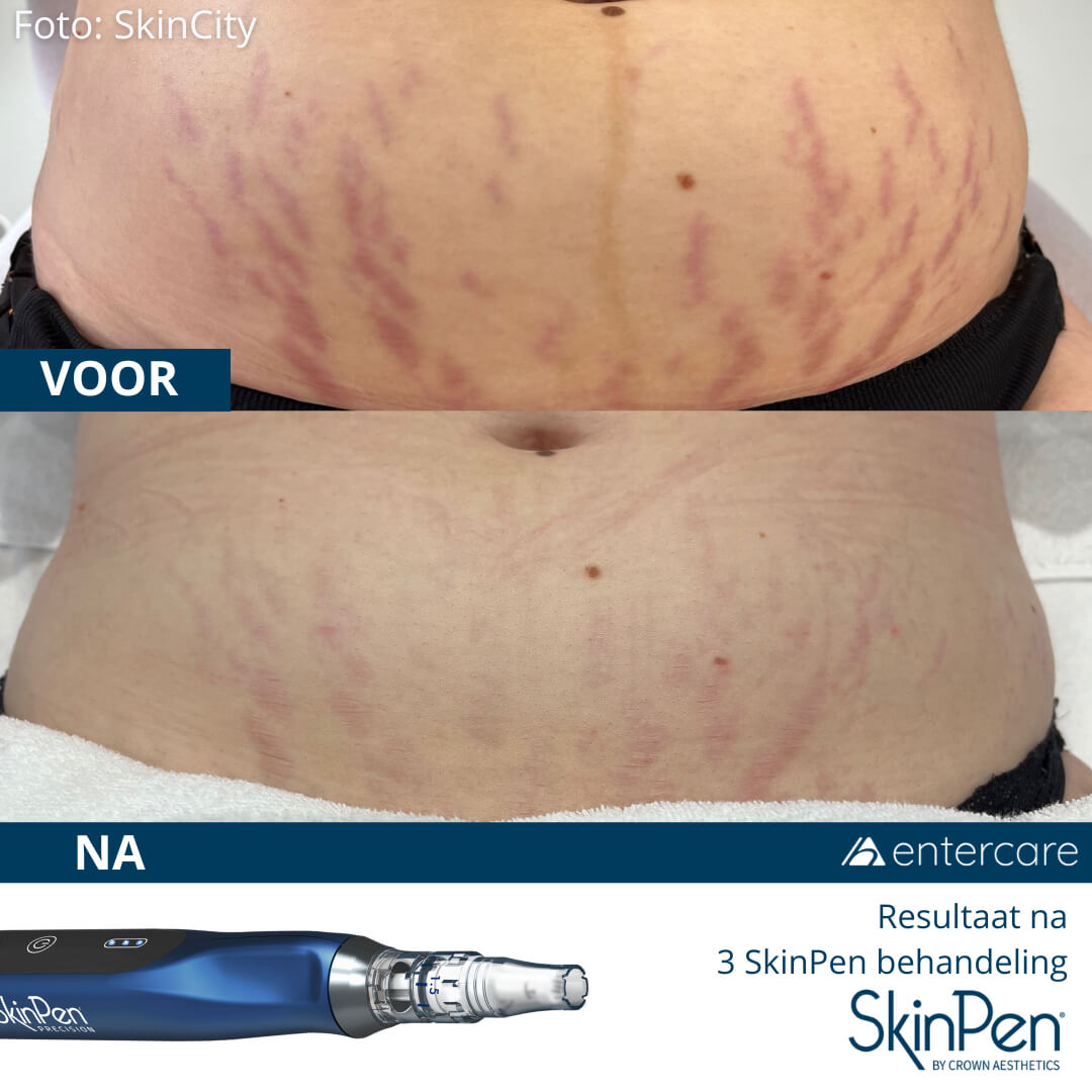 SkinPen voor en na striae