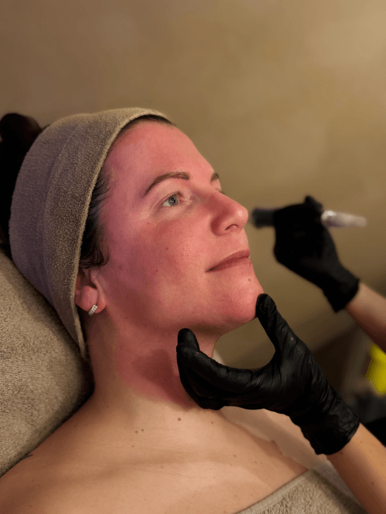 Huidcoach voert SkinPen microneedling uit op de wang van een cliënte