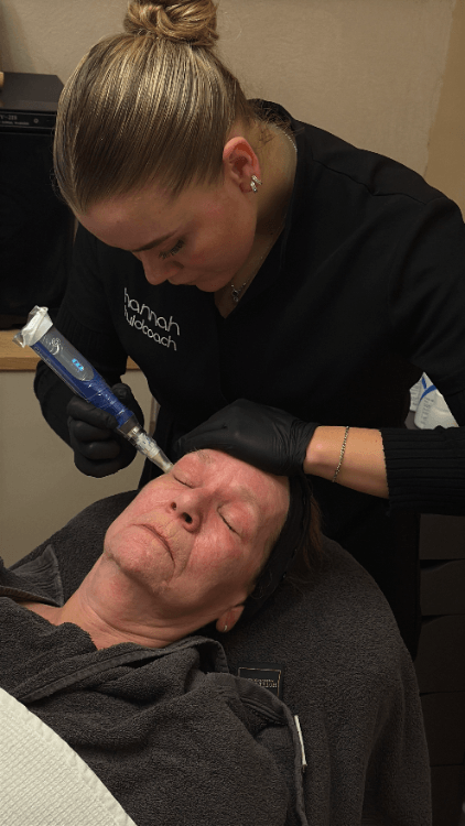Huidcoach voert SkinPen microneedling uit op voorhoofd van cliënte