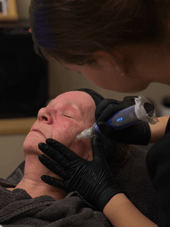 Huidcoach behandelt wang en kaak met SkinPen microneedling apparaat bij Puur Diana