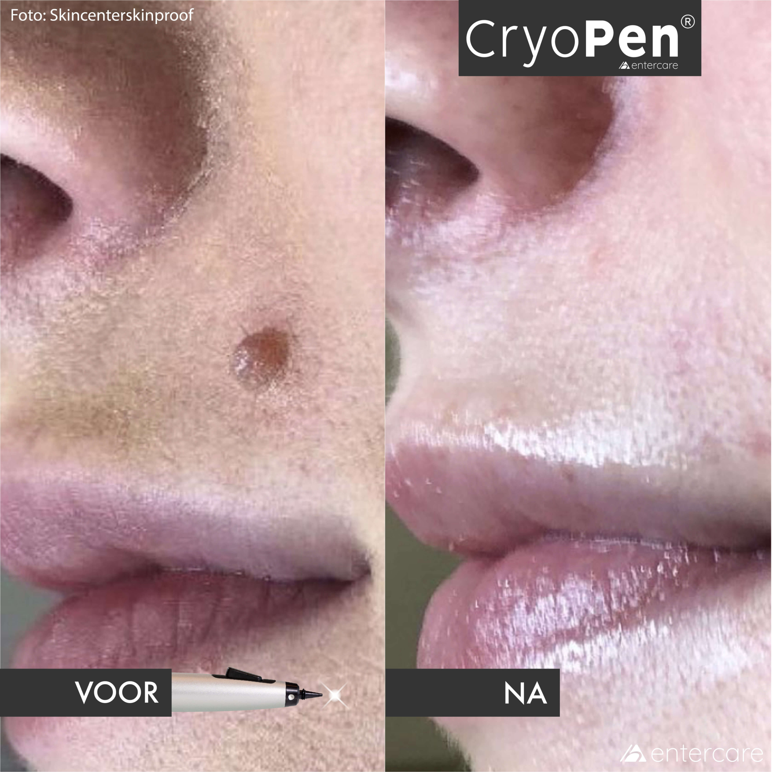 Resultaat van CryoPen behandeling bij een geschikte huidoneffenheid