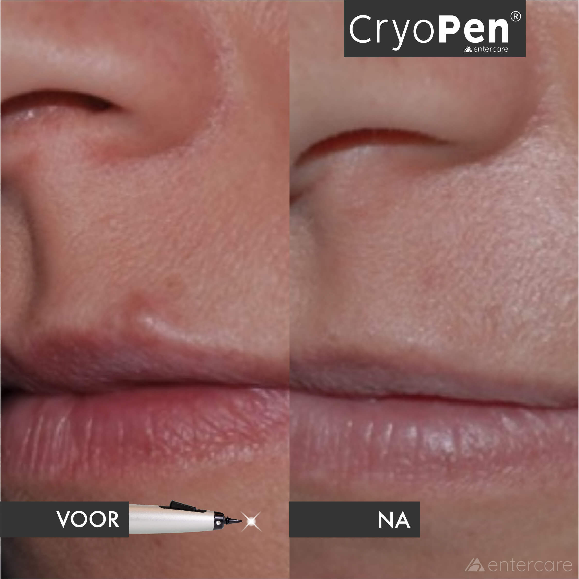 Voor en na voorbeeld van een huidoneffenheid behandeld met CryoPen
