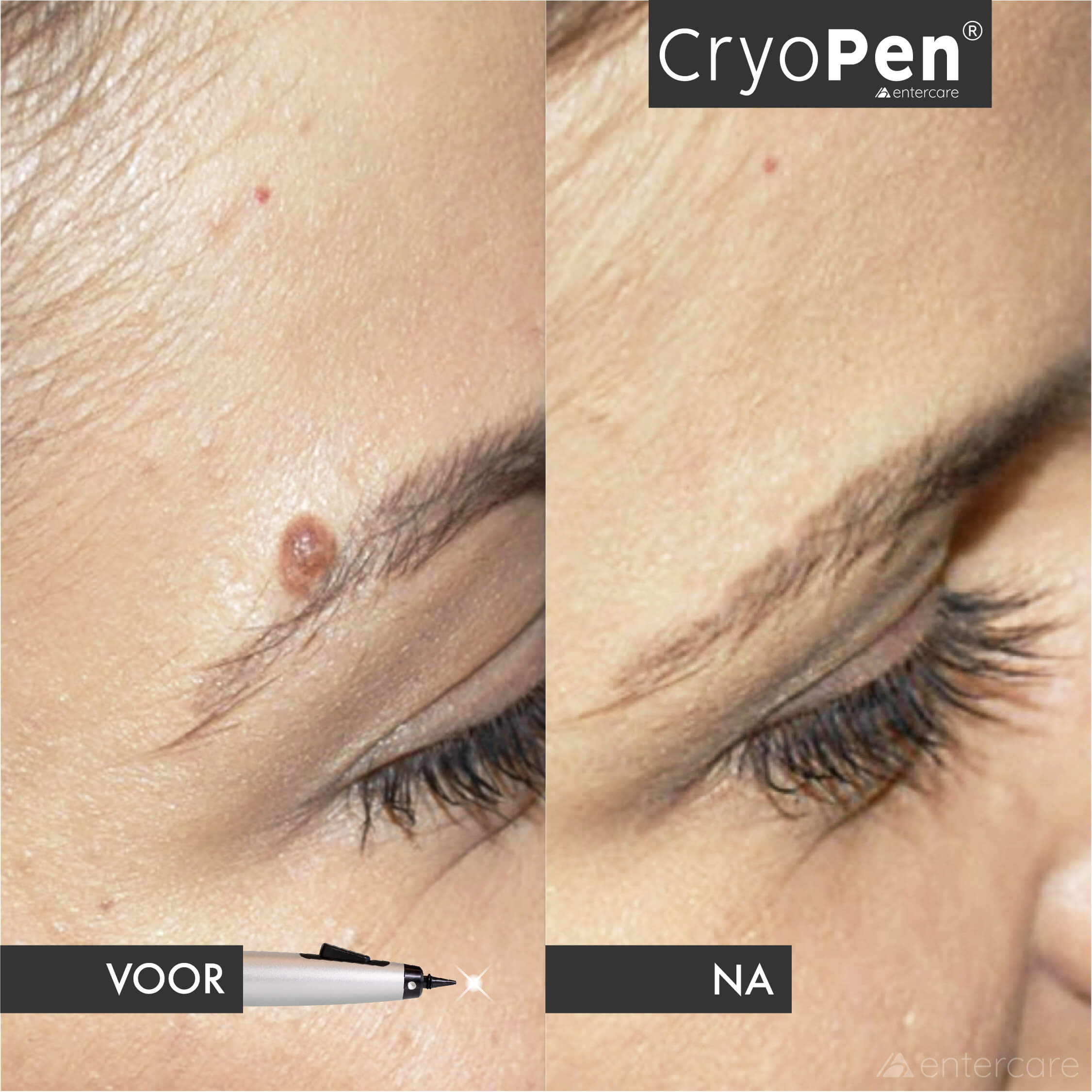 Voorbeeld van een huidoneffenheid behandeld met CryoPen bij Puur Diana
