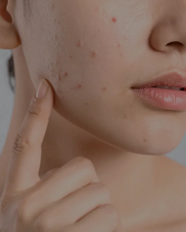 Acne Deep Cleansing behandelstappen bij Puur Diana