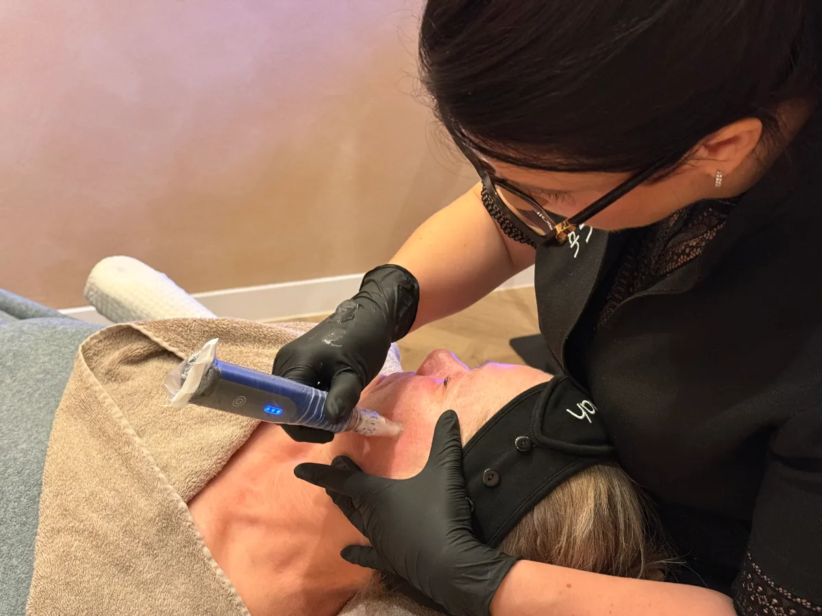 SkinPen microneedling van de wang