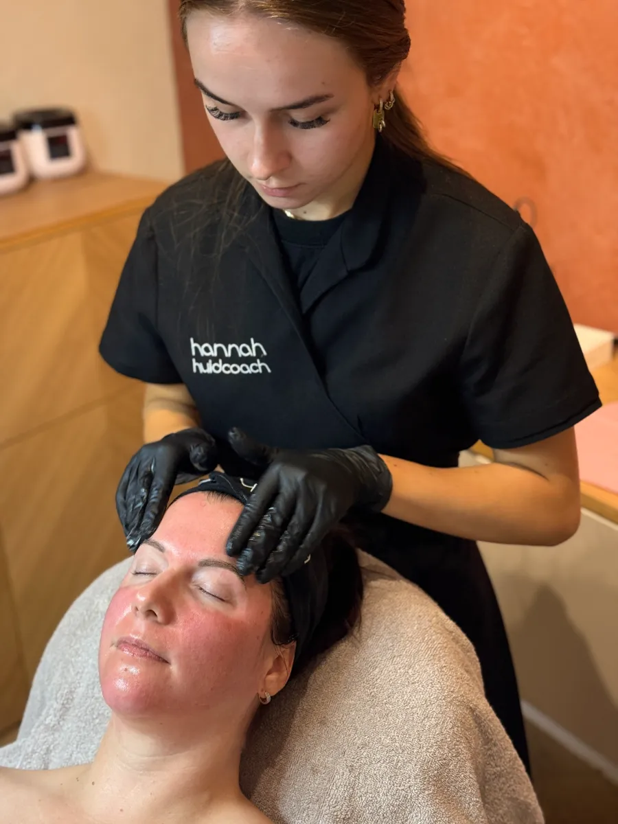 Diana tijdens de SkinPen behandeling