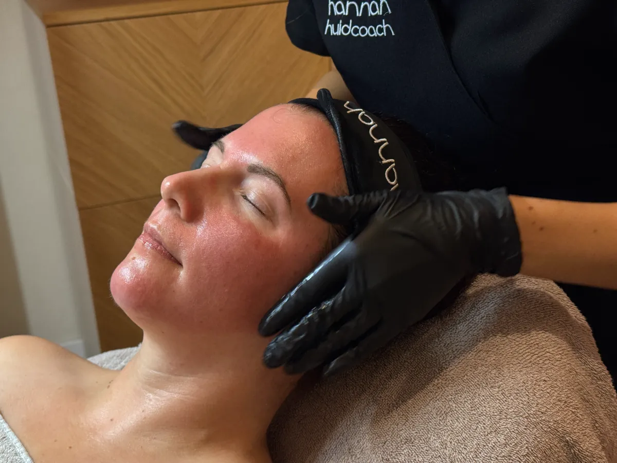 Normale roodheid direct na SkinPen microneedling